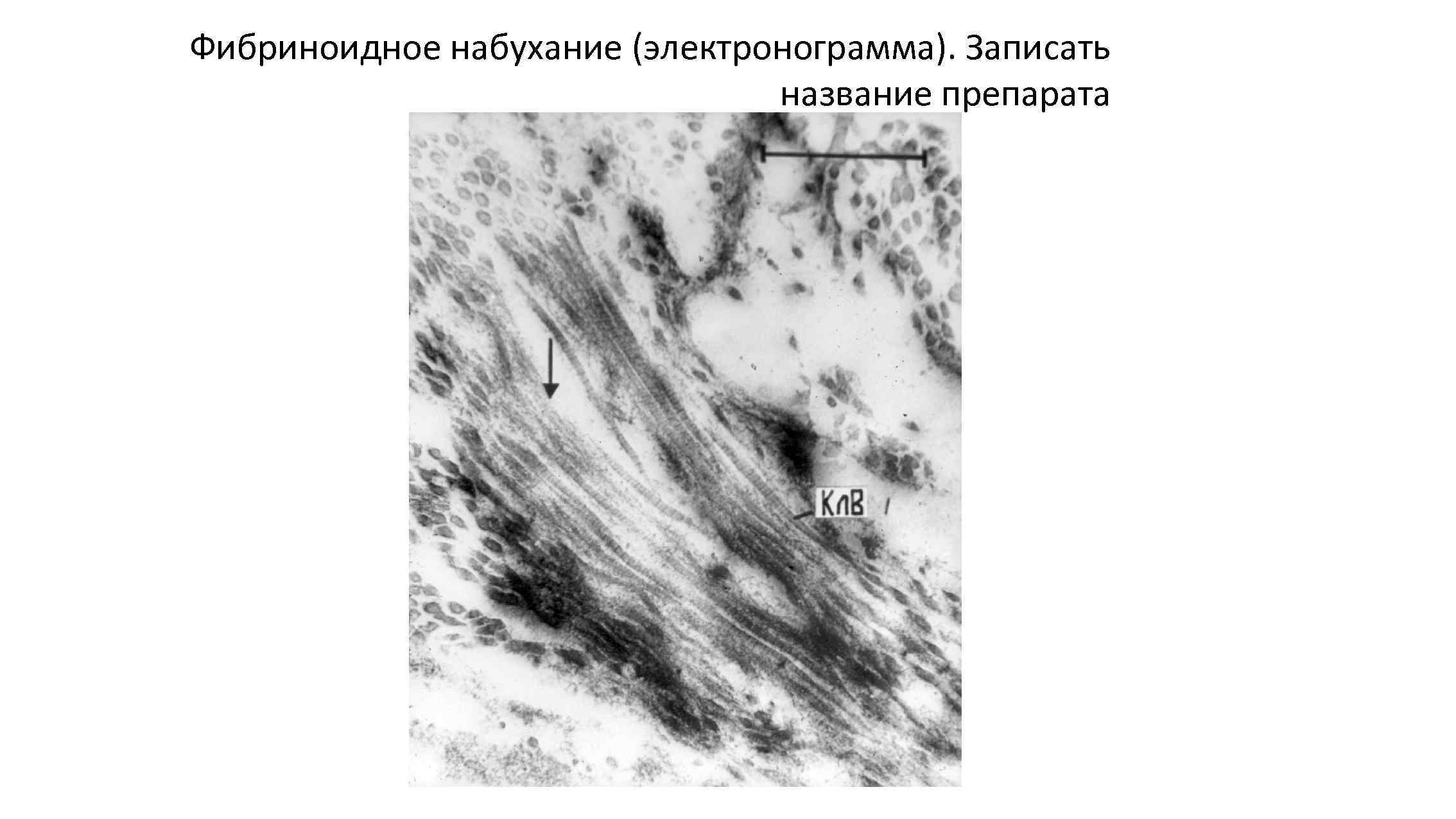 Фибриноидное набухание (электронограмма). Записать название препарата 