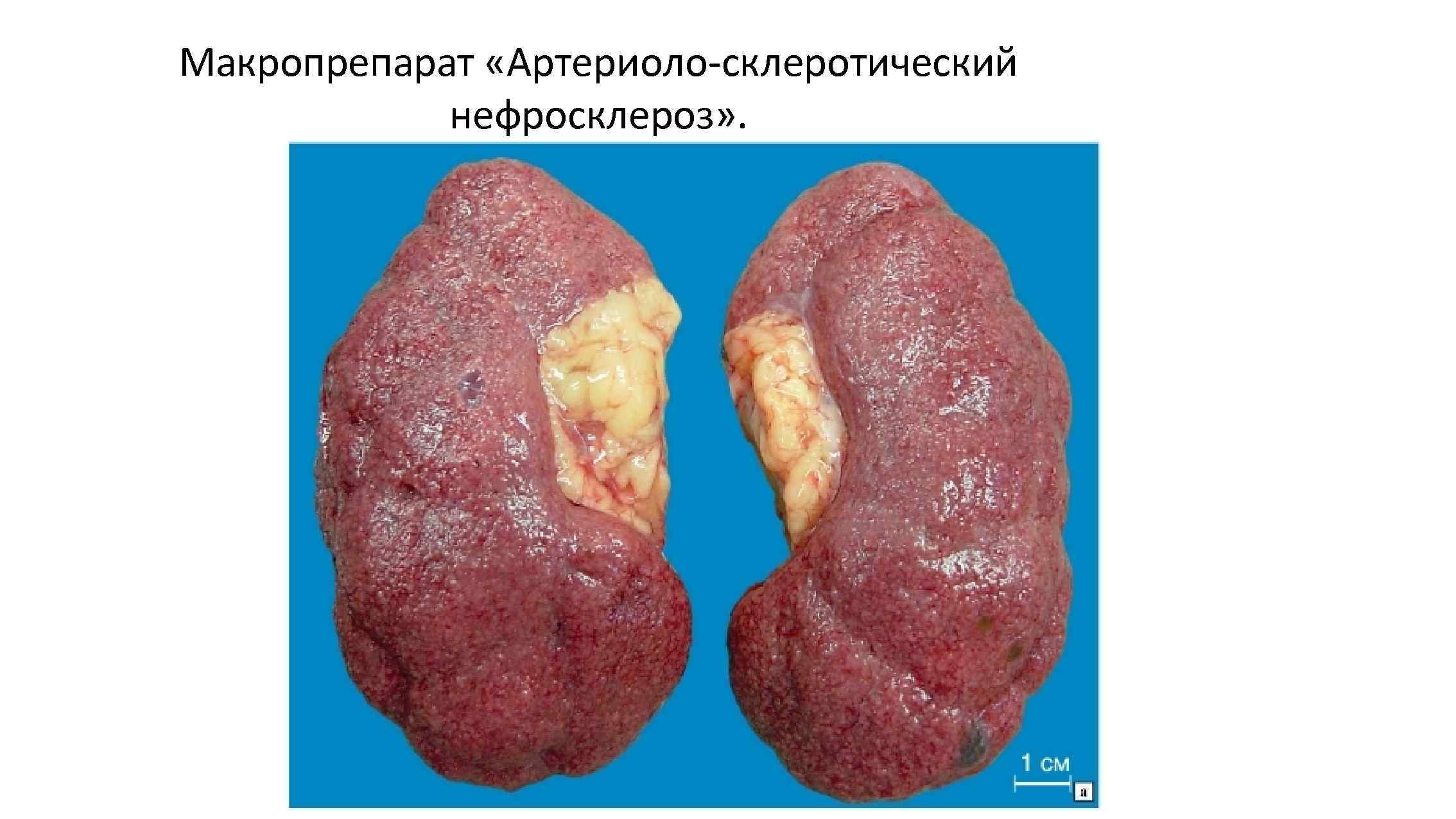 Макропрепарат «Артериоло-склеротический нефросклероз» . 