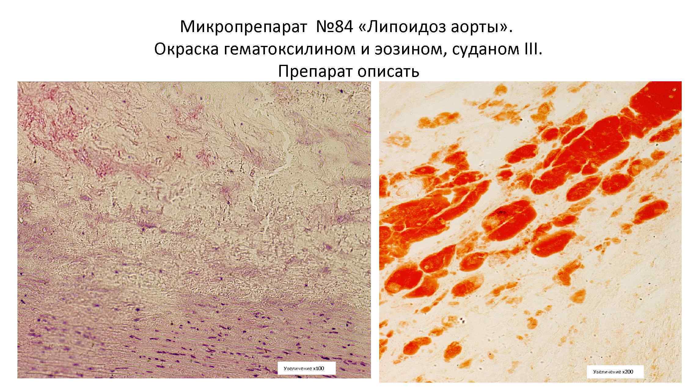 Жировая дистрофия миокарда