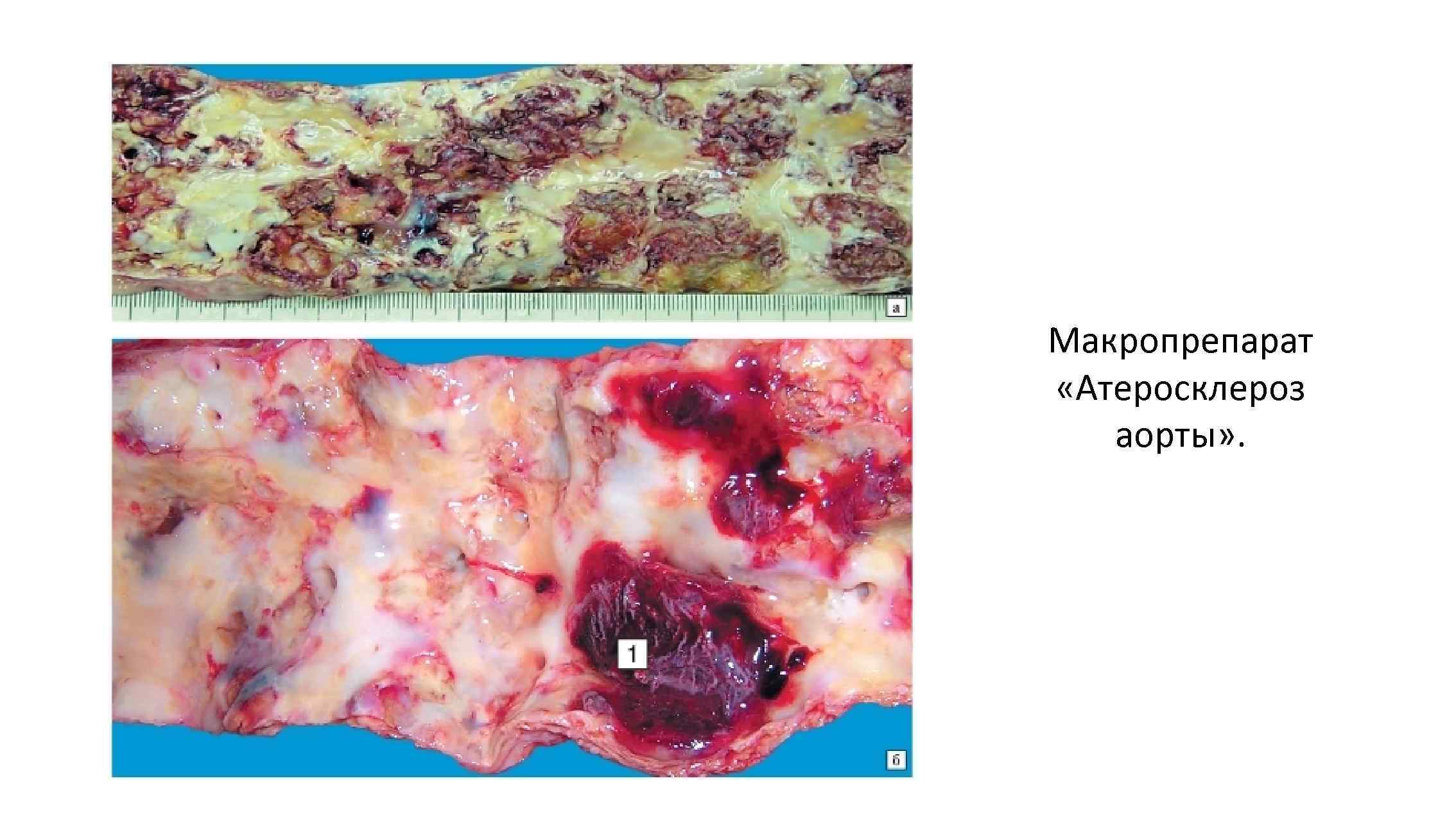 Макропрепарат «Атеросклероз аорты» . 