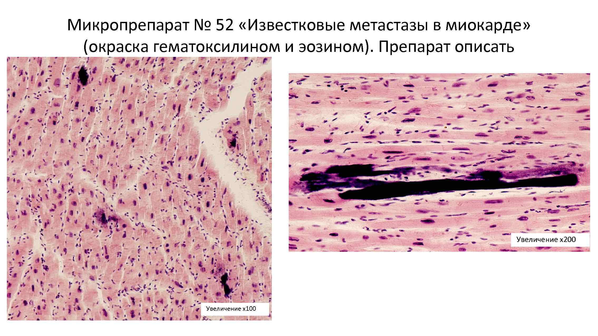 Микропрепарат № 52 «Известковые метастазы в миокарде» (окраска гематоксилином и эозином). Препарат описать Увеличение