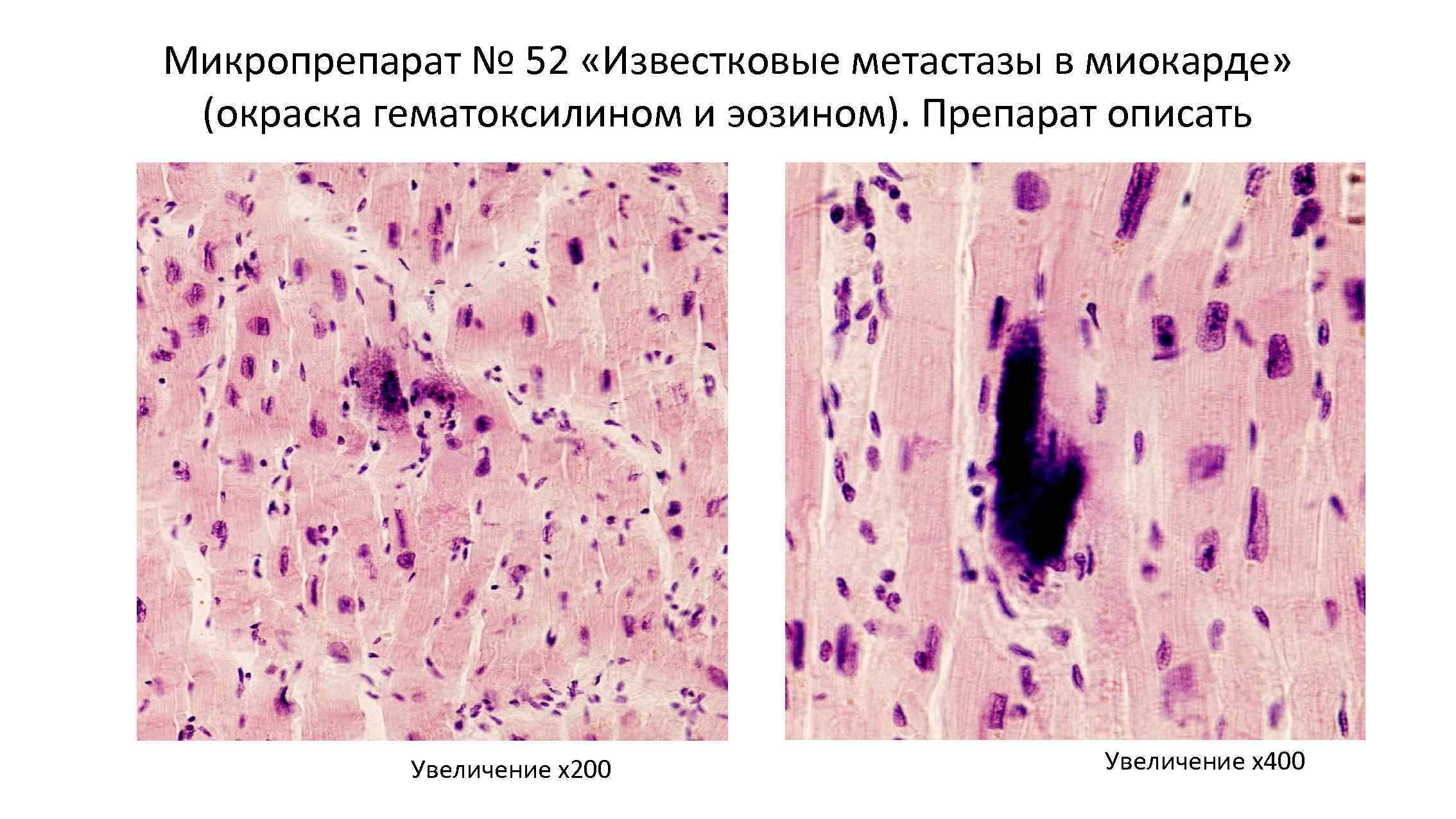 Известковые метастазы в миокарде микропрепарат