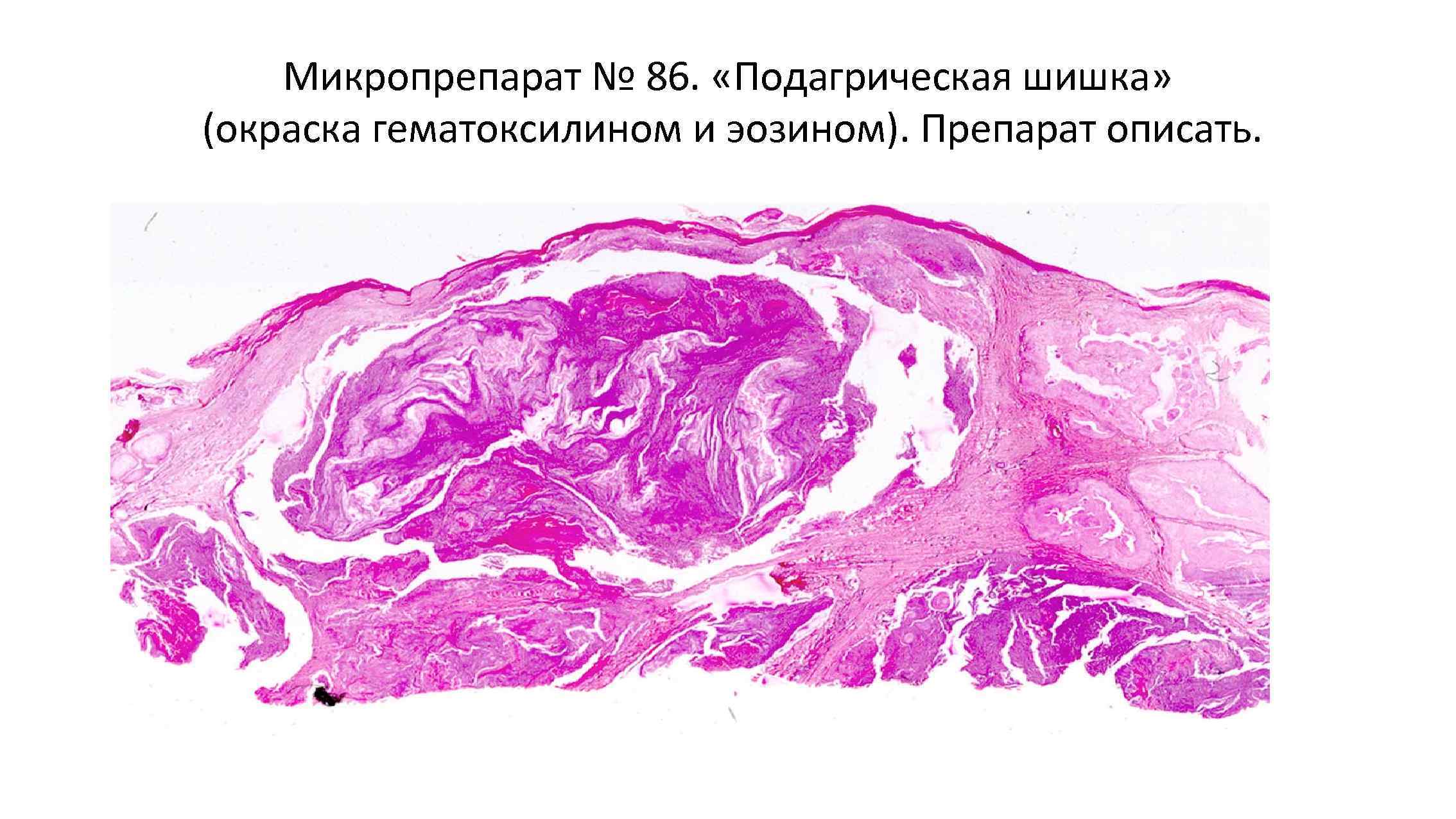 Трубная беременность микропрепарат. Микропрепарат Трубная беременность патанатомия. Трубная беременность патологическая анатомия микропрепараты. Подагрический тофус гистология. Подагра патоморфология гистология.