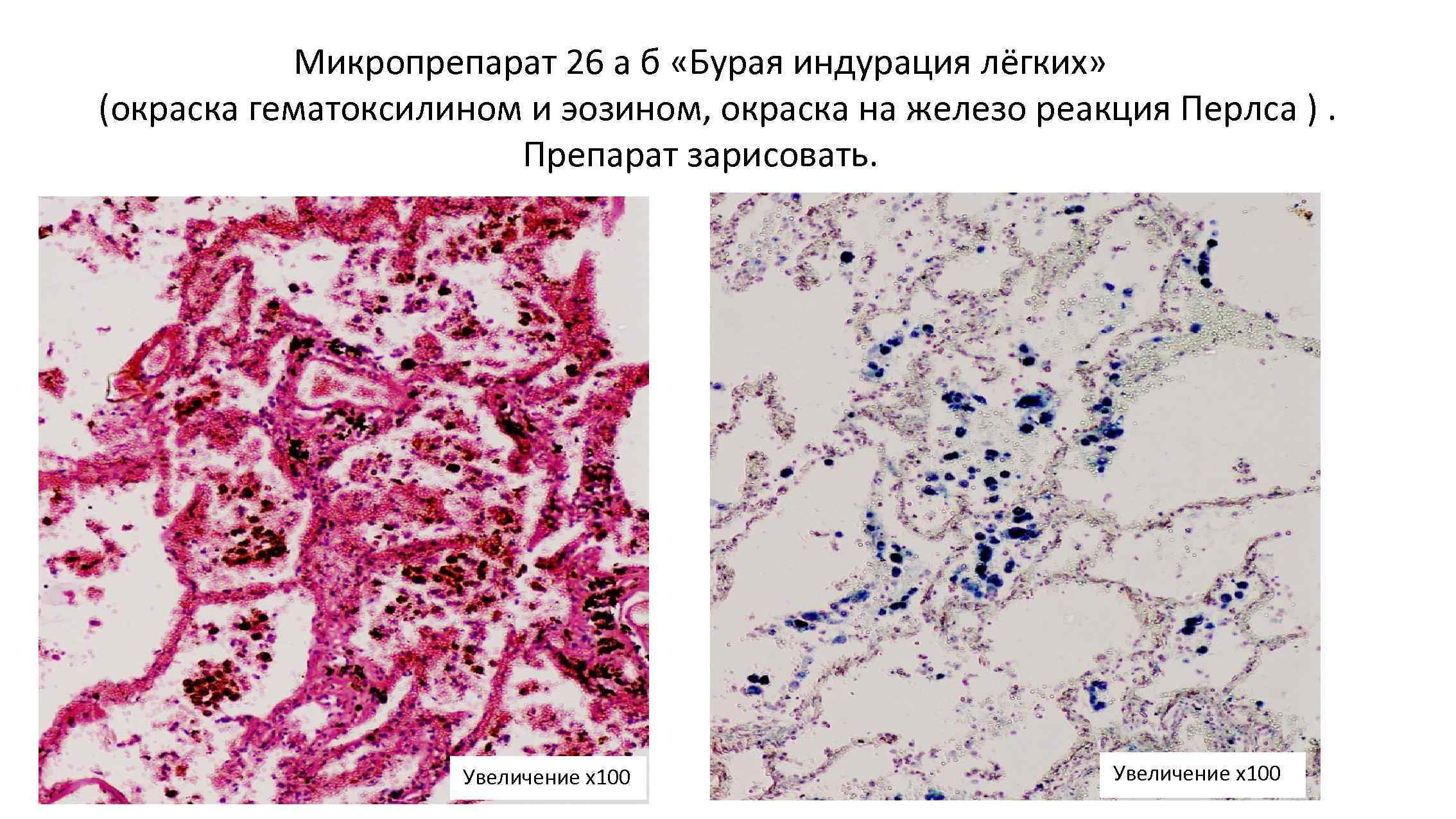 Микропрепарат 26 а б «Бурая индурация лёгких» (окраска гематоксилином и эозином, окраска на железо