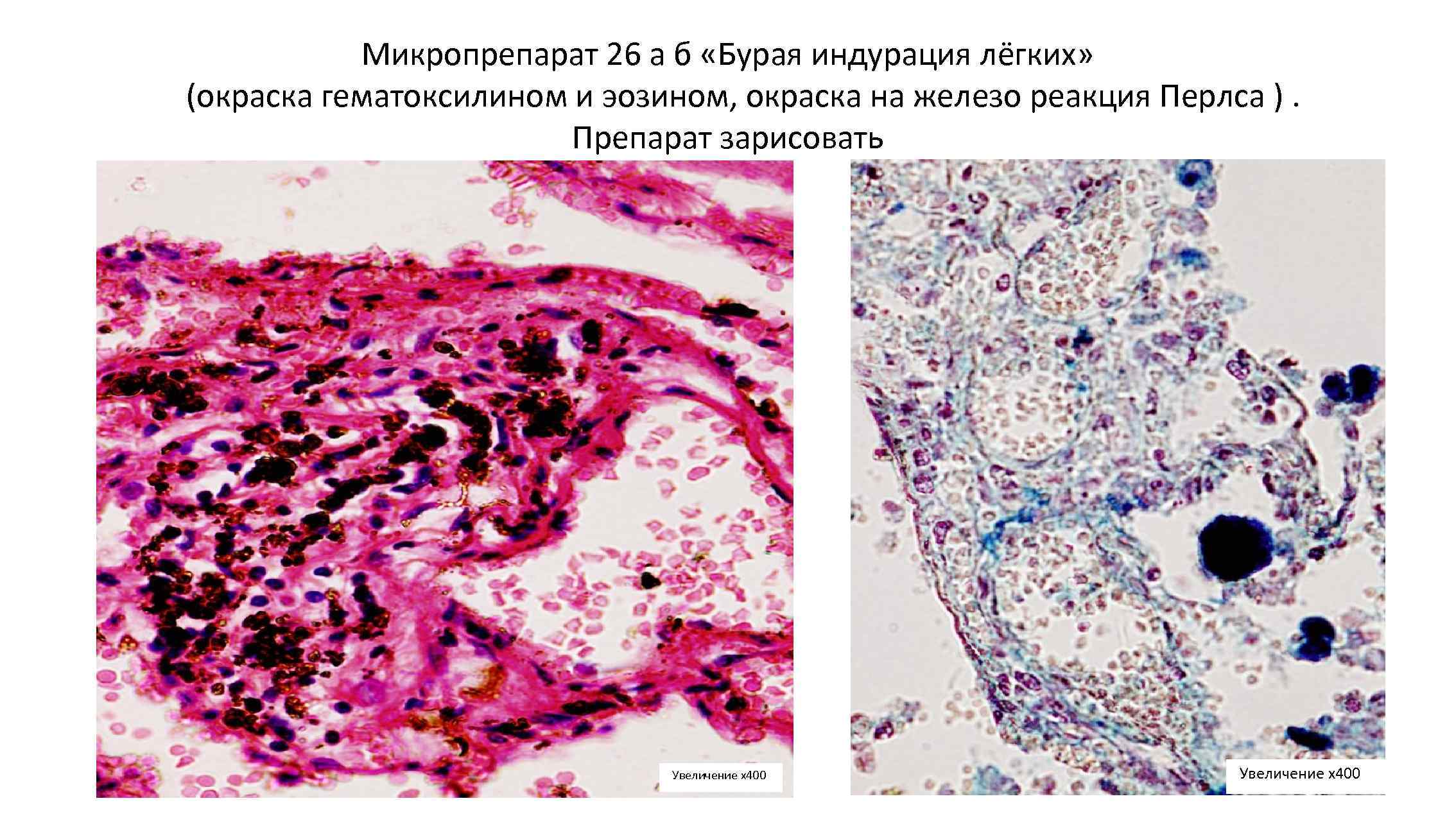 Бурая атрофия печени микропрепарат рисунок