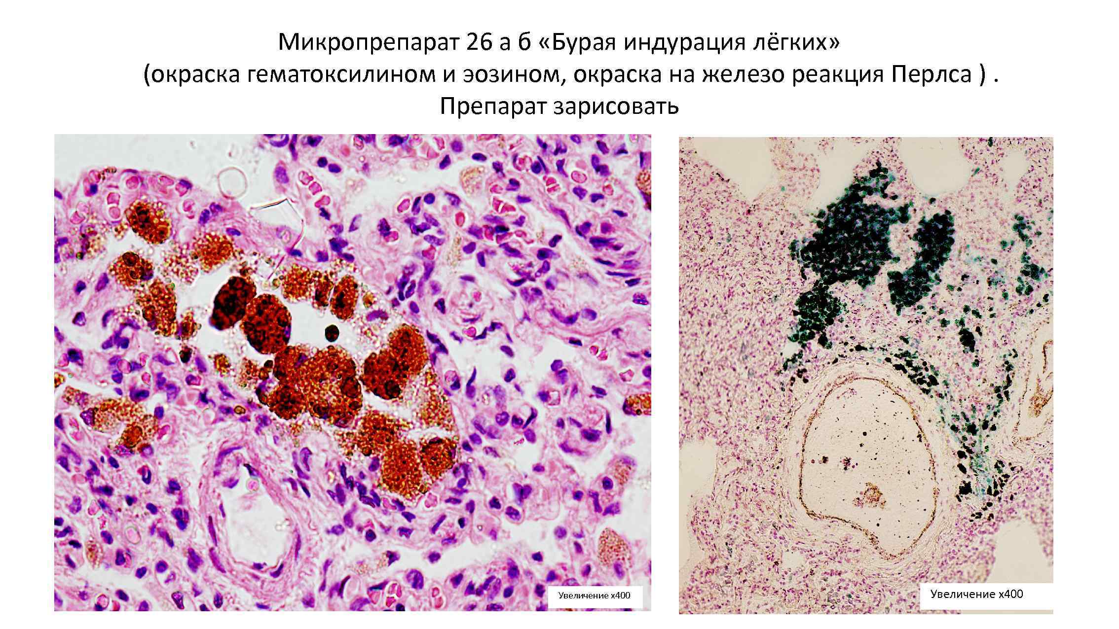 Микропрепарат 26 а б «Бурая индурация лёгких» (окраска гематоксилином и эозином, окраска на железо