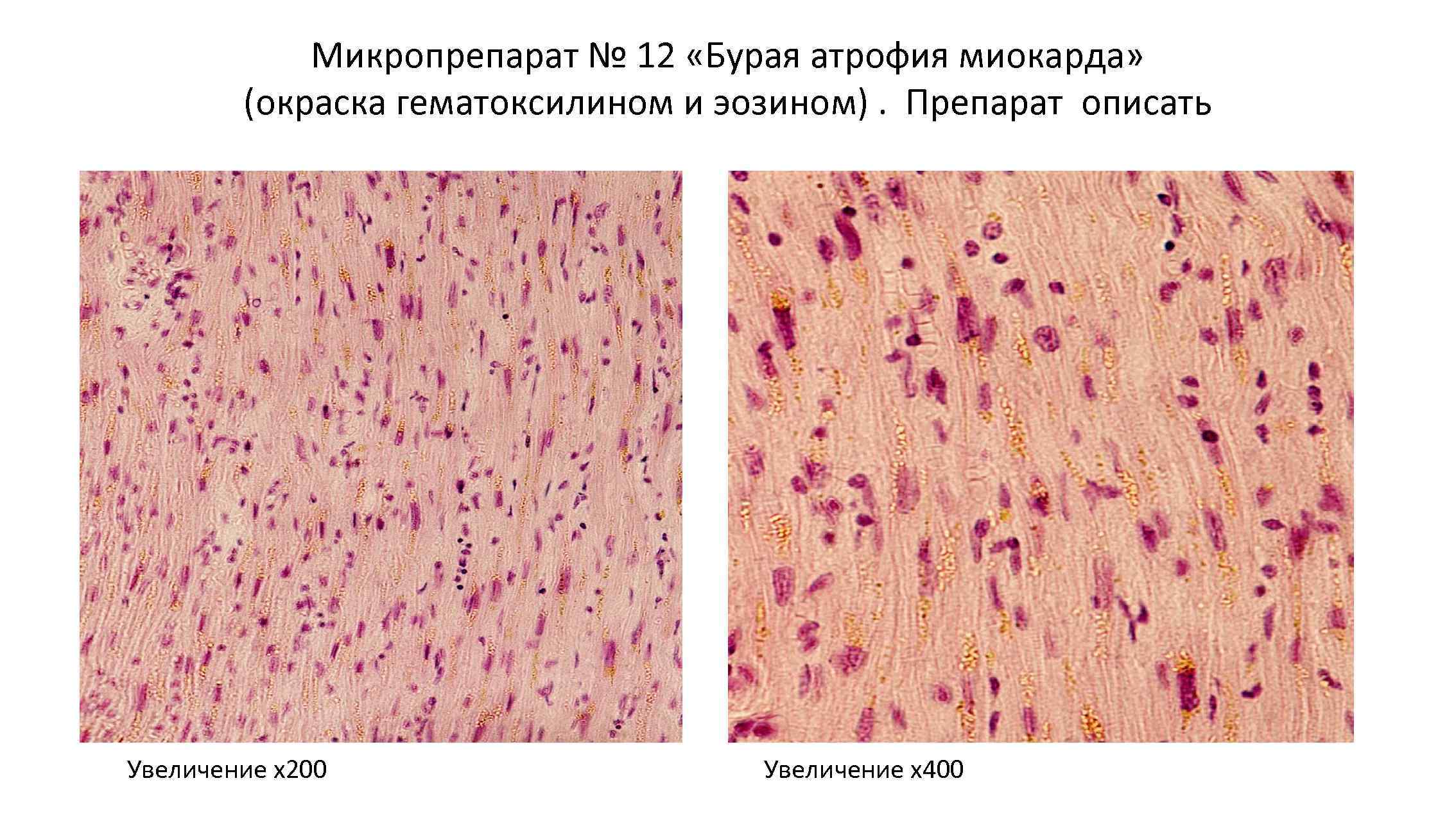 Микропрепарат № 12 «Бурая атрофия миокарда» (окраска гематоксилином и эозином). Препарат описать Увеличение х200