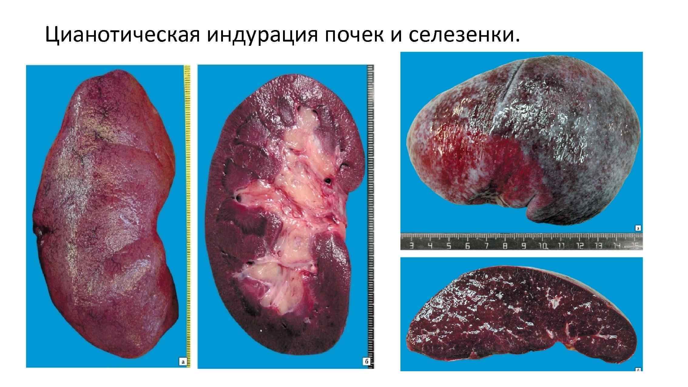 Цианотическая индурация почек и селезенки. 