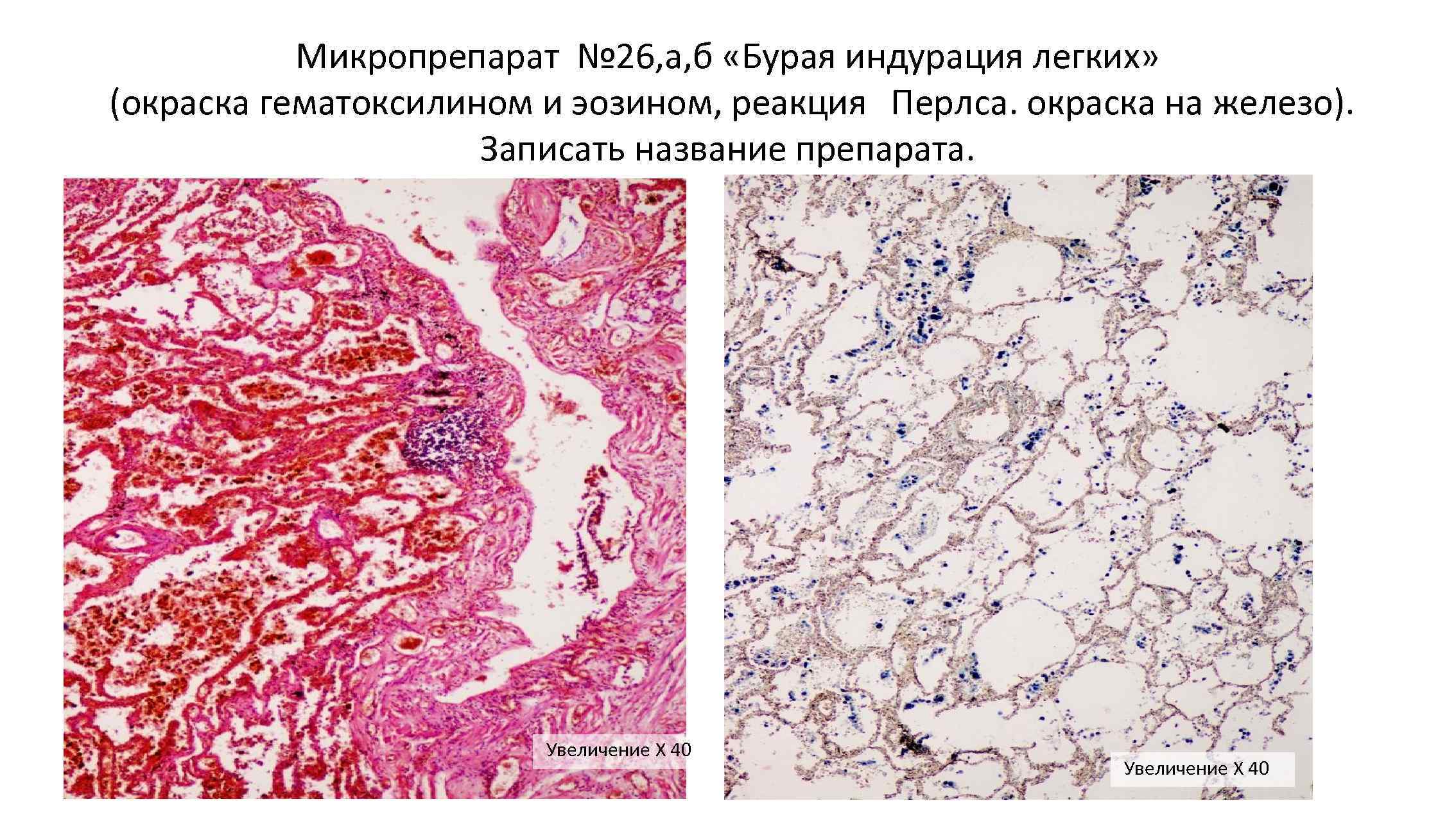 Описание микропрепарата. Бурая индурация легкого патанатомия. Бурая индурация легких патологическая анатомия. Бурая индурация легких реакция Перлса. Бурая индурация лёгких микропрепарат.