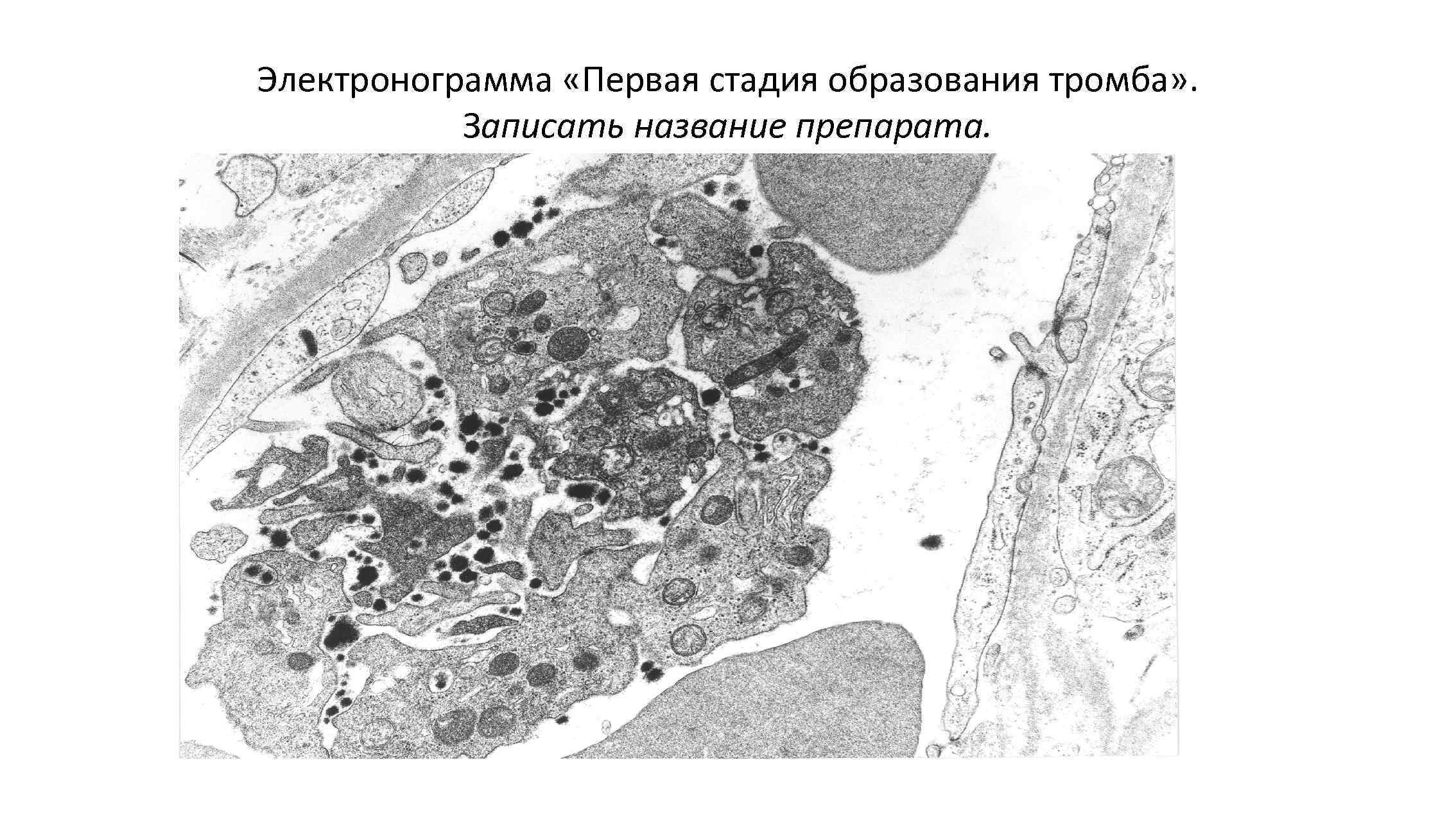 Электронограмма «Первая стадия образования тромба» . Записать название препарата. 