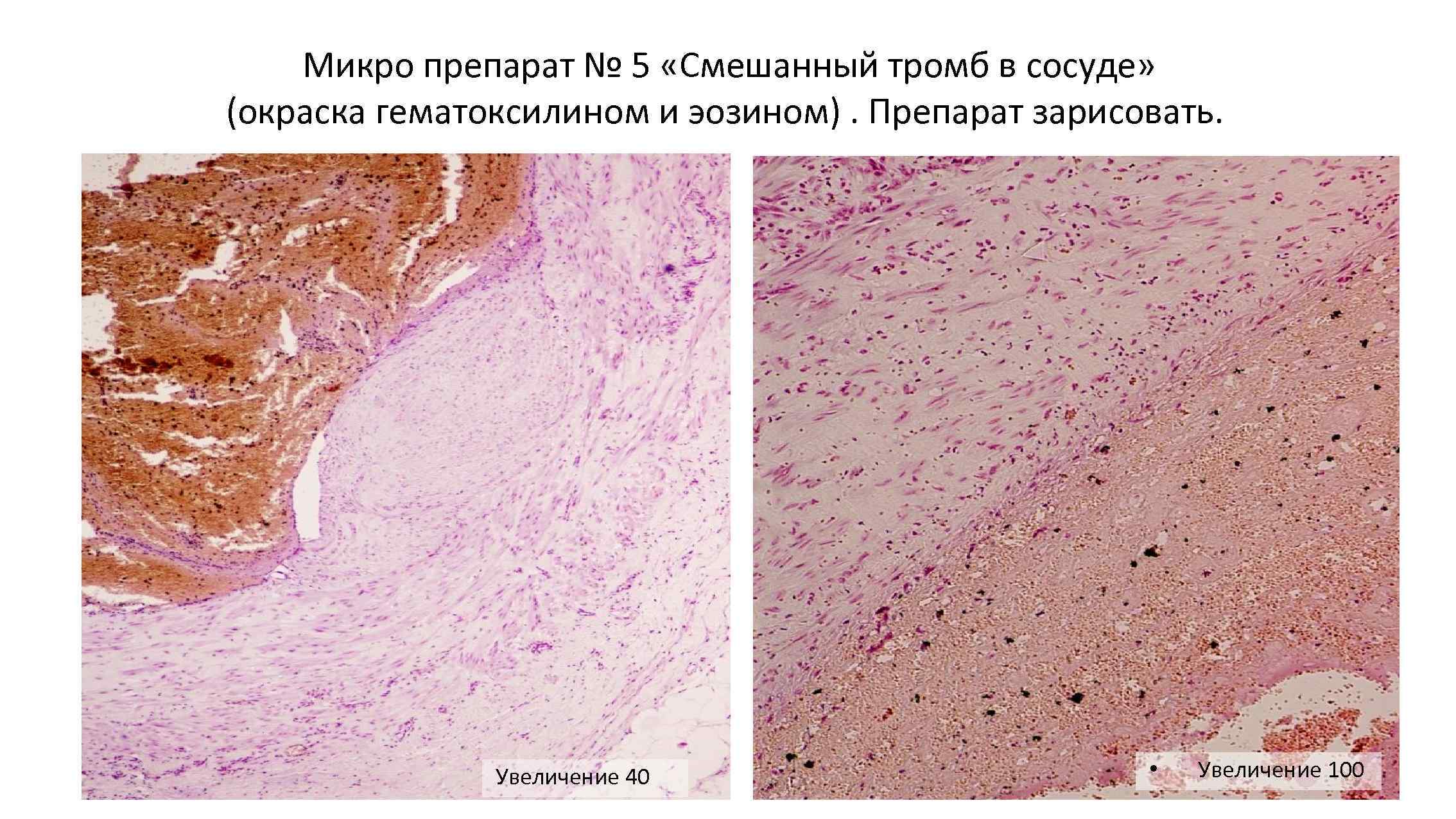 Тромб в сосуде на экране уз сканера выглядят как