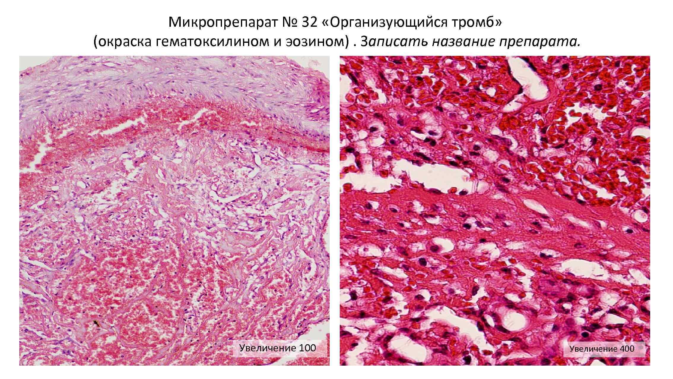 Микропрепарат № 32 «Организующийся тромб» (окраска гематоксилином и эозином). Записать название препарата. Увеличение 100