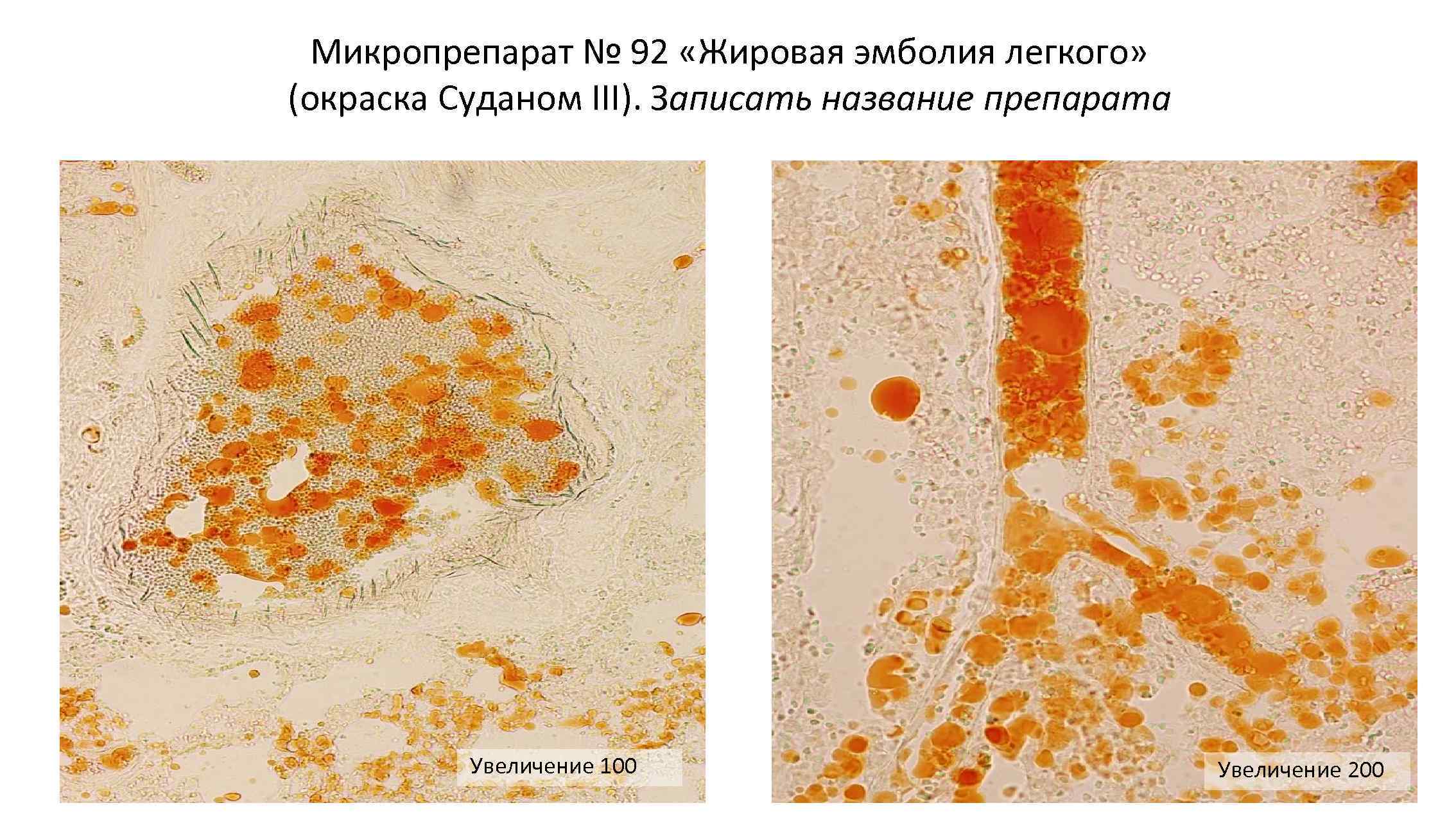 Силикоз легкого микропрепарат рисунок