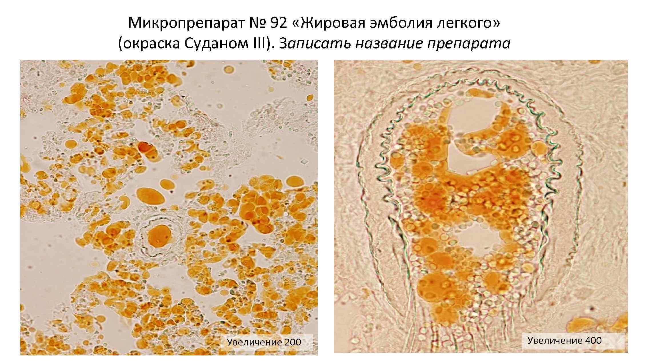 Увеличение 200. Жировая эмболия легкого микропрепарат Судан 3. Жировая эмболия лёгкого микропрепарат. Жировая эмболия легких микропрепарат. Жировая эмболия сосудов Суданом 3 легкого микропрепарат.