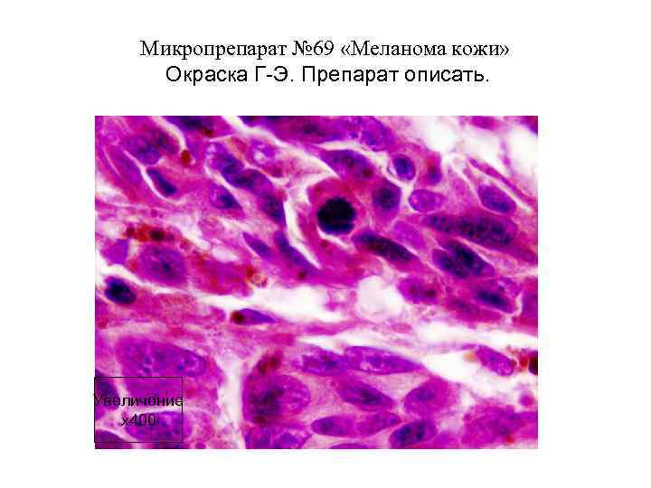 Микропрепарат № 69 «Меланома кожи» Окраска Г-Э. Препарат описать. Увеличение х400 