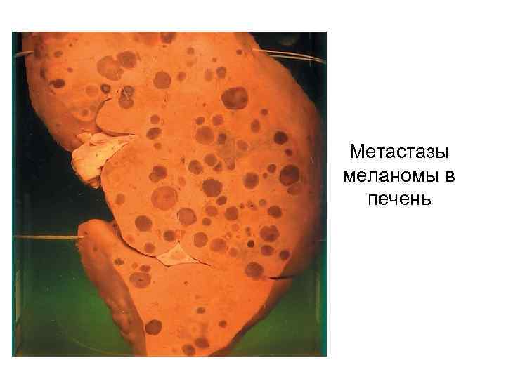 Метастазы меланомы в печень 