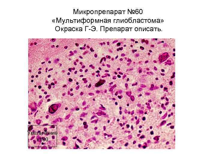 Микропрепарат № 60 «Мультиформная глиобластома» Окраска Г-Э. Препарат описать. Увеличение х100 