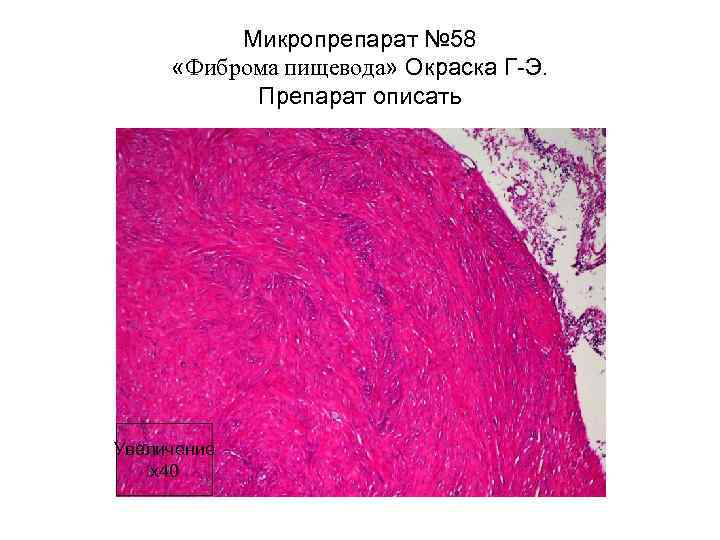 Микропрепарат № 58 «Фиброма пищевода» Окраска Г-Э. Препарат описать Увеличение х40 