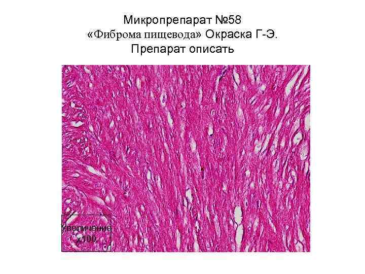 Микропрепарат № 58 «Фиброма пищевода» Окраска Г-Э. Препарат описать Увеличение х100 