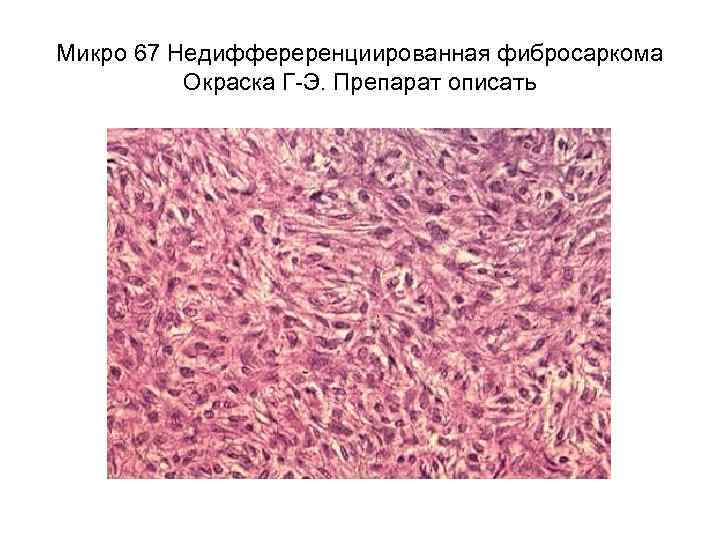 Микро 67 Недиффереренциированная фибросаркома Окраска Г-Э. Препарат описать 