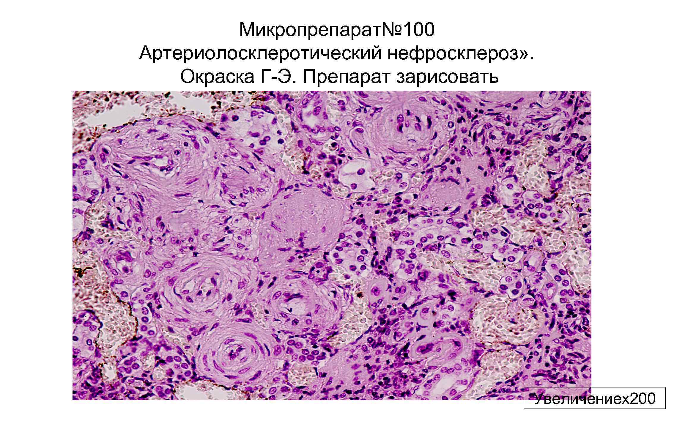 Артериолосклеротический нефросклероз микропрепарат рисунок