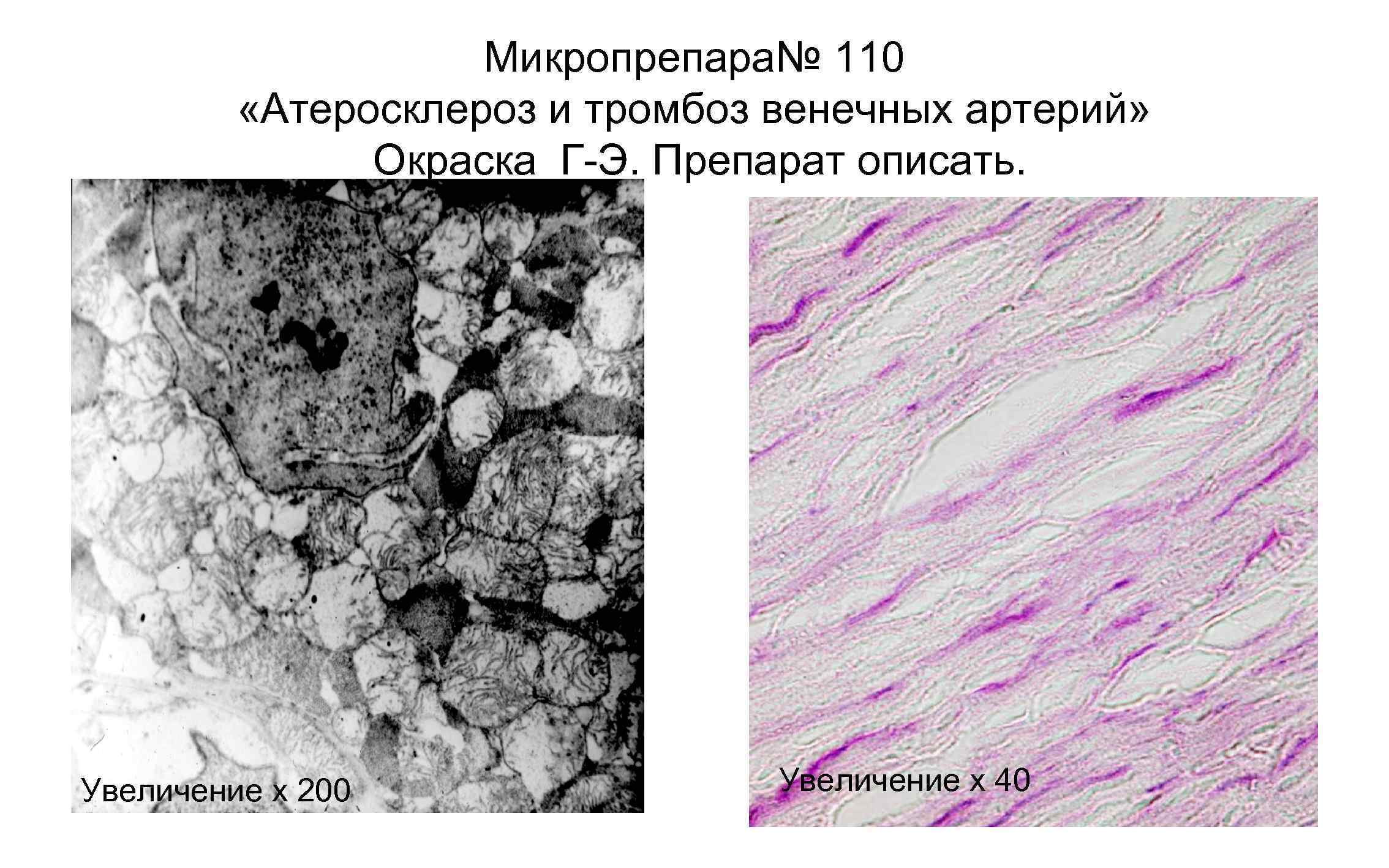 Микропрепара№ 110 «Атеросклероз и тромбоз венечных артерий» Окраска Г Э. Препарат описать. Увеличение х