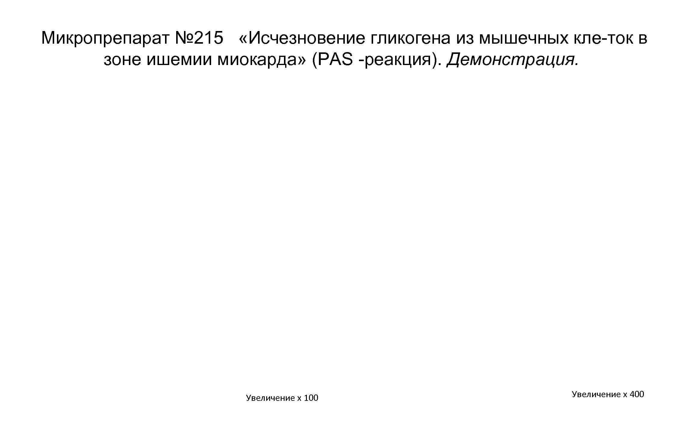 Микропрепарат № 215 «Исчезновение гликогена из мышечных кле ток в зоне ишемии миокарда» (РАS