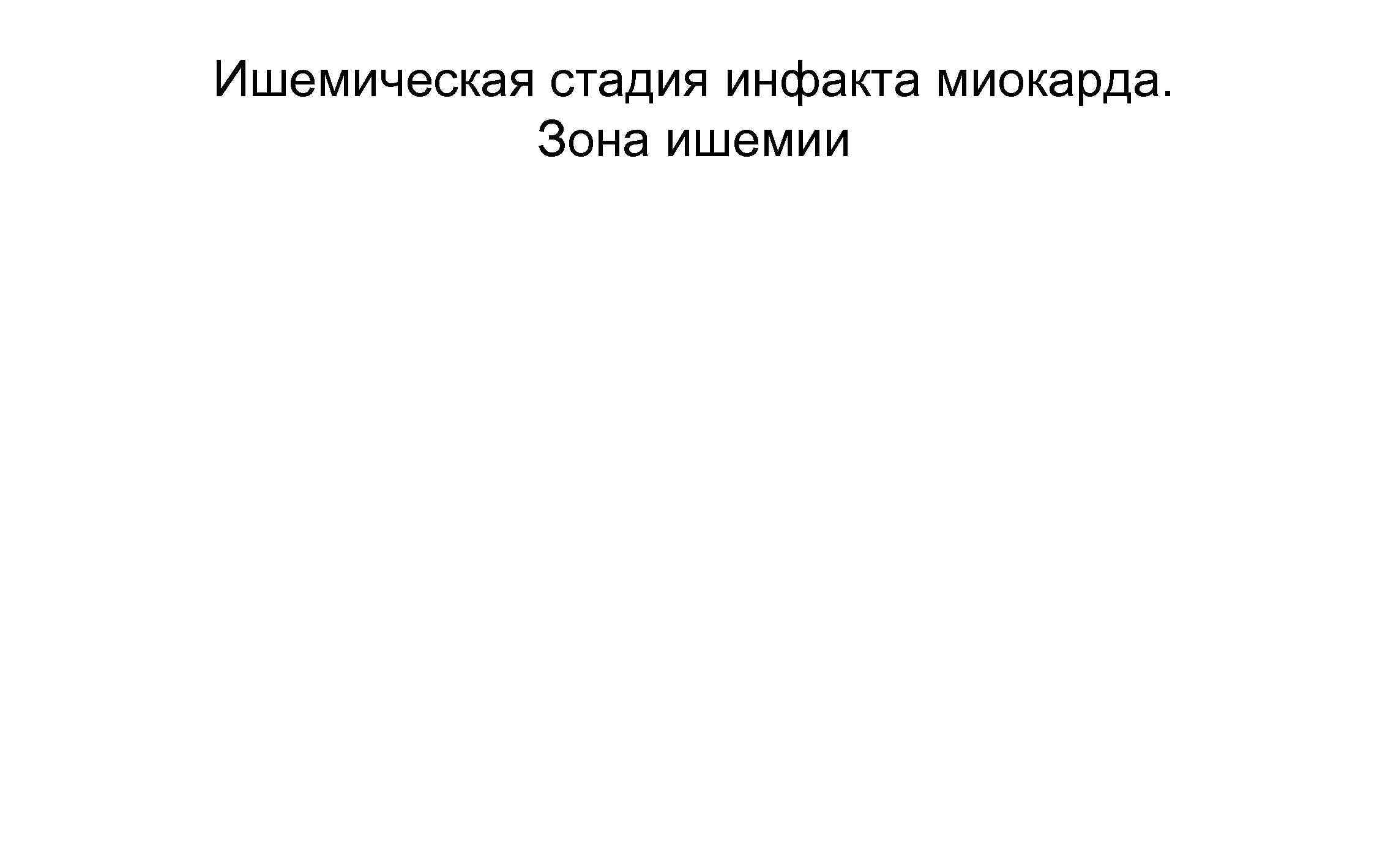 Ишемическая стадия инфакта миокарда. Зона ишемии 