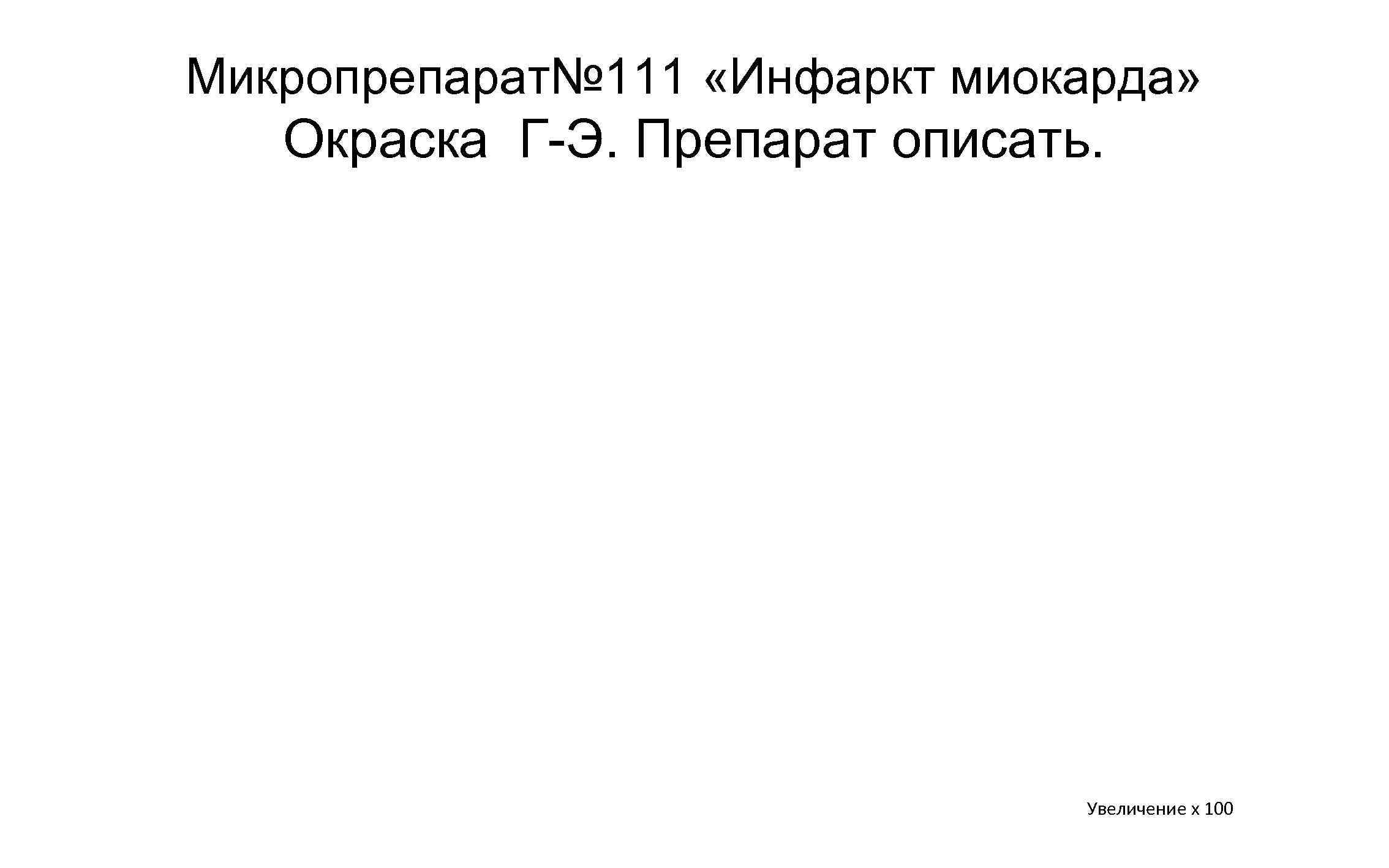 Микропрепарат№ 111 «Инфаркт миокарда» Окраска Г Э. Препарат описать. Увеличение х 100 