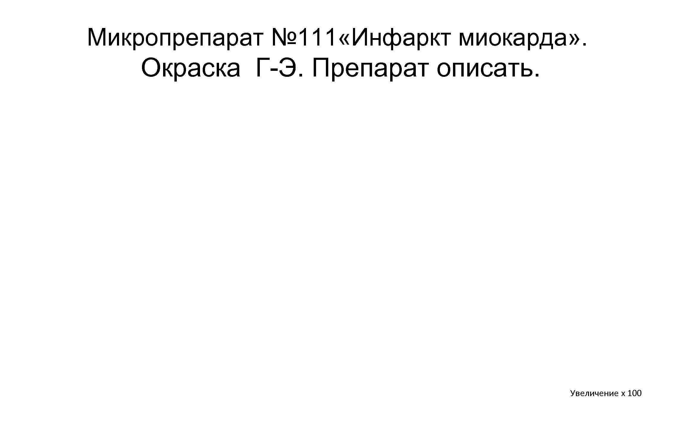 Микропрепарат № 111 «Инфаркт миокарда» . Окраска Г Э. Препарат описать. Увеличение х 100