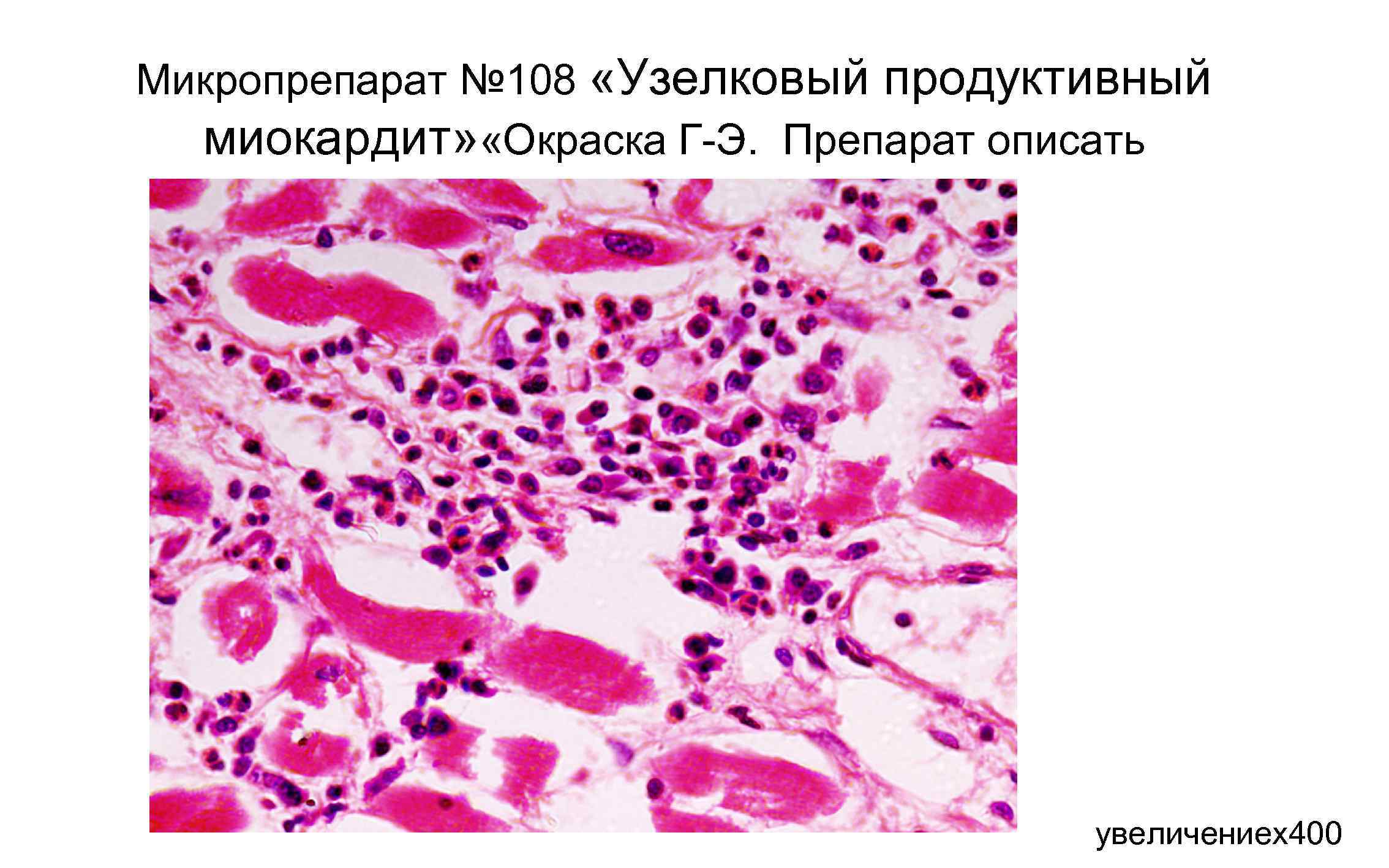 Ревматический миокардит микропрепарат рисунок