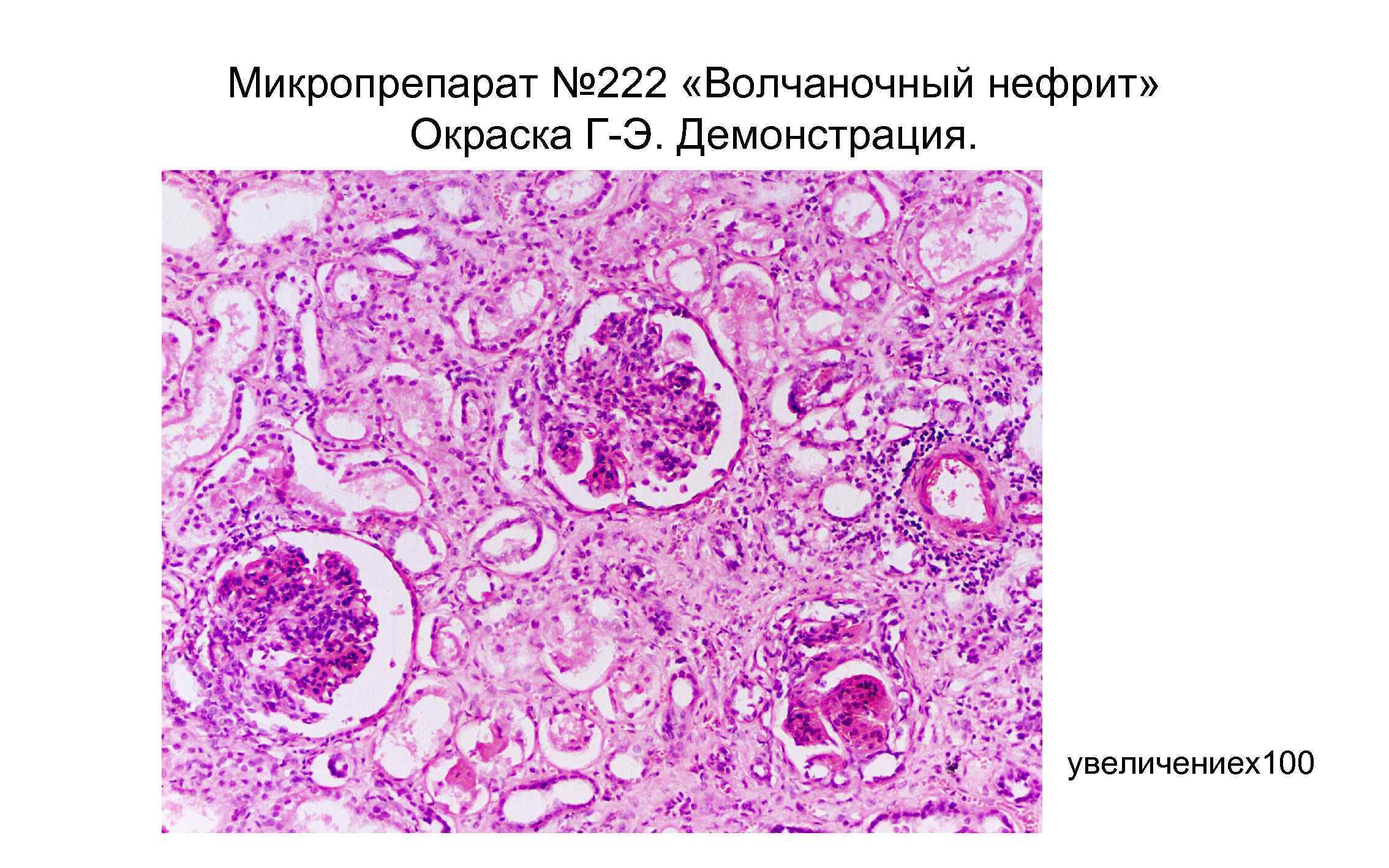 Нефрит болезнь