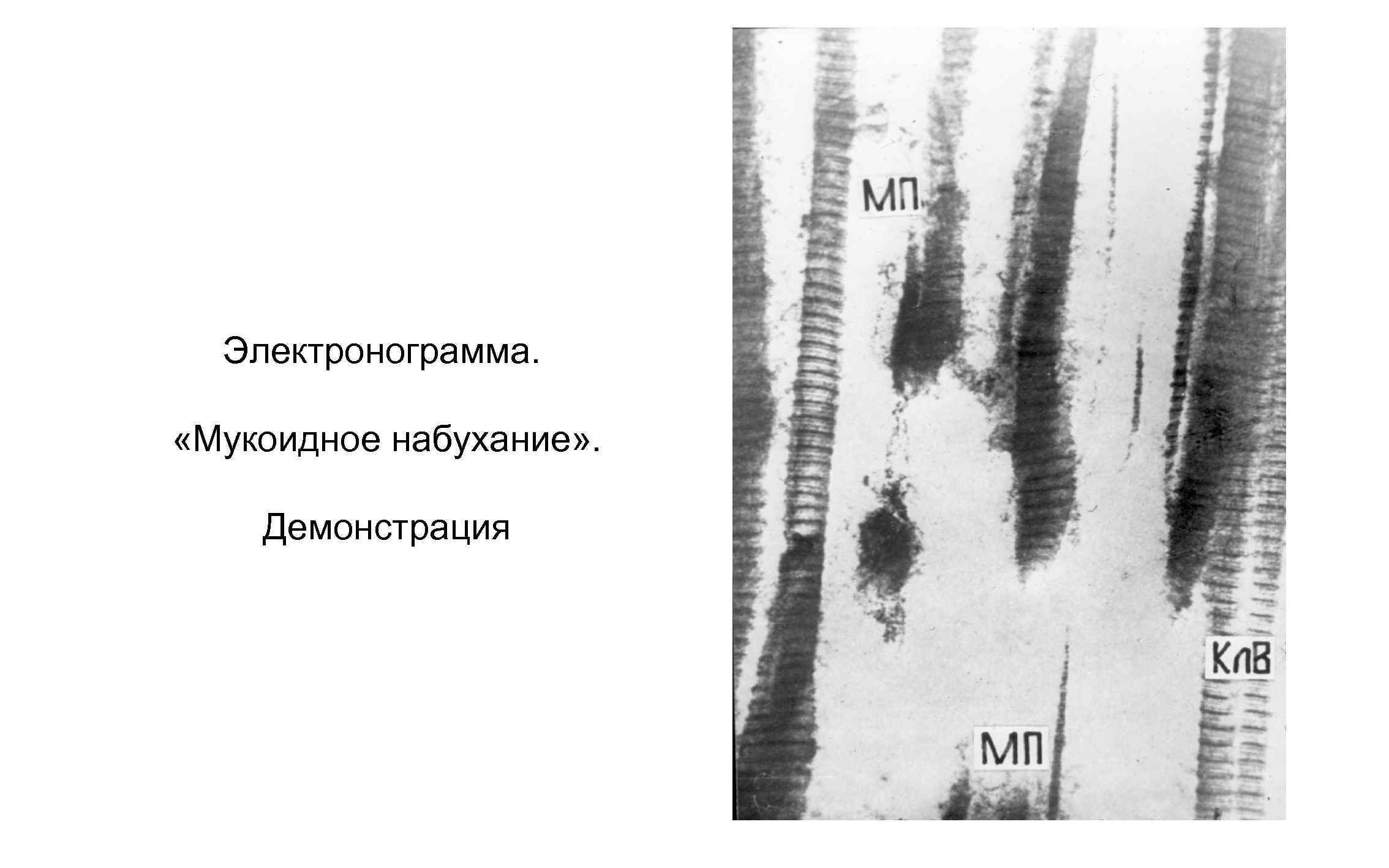 Электронограмма. «Мукоидное набухание» . Демонстрация 