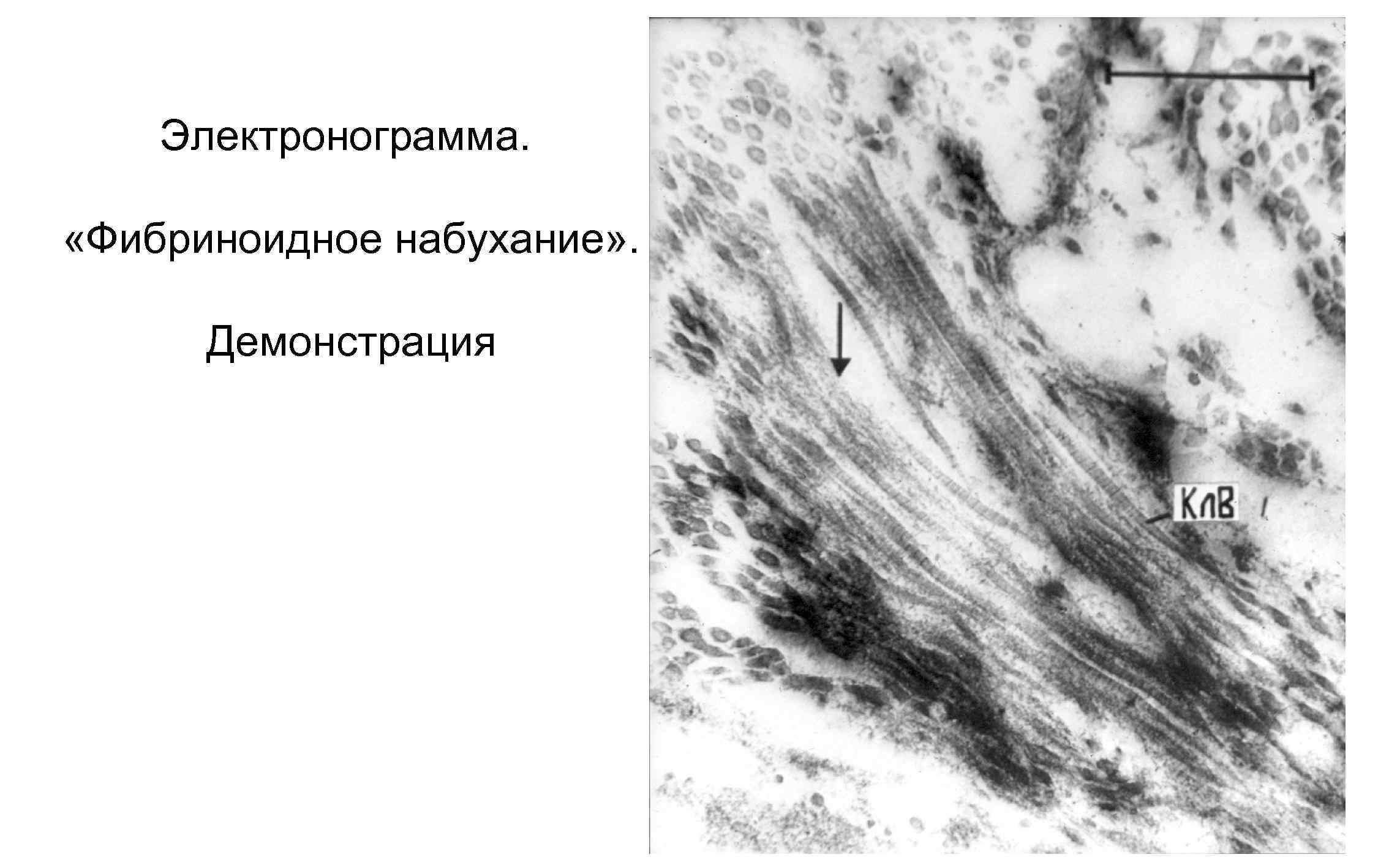 Фибриноидное набухание это. Фибриноидное набухание Электронограмма. Мукоидное набухание Электронограмма. Фибриноидное набухание микроскопия. Фибриноидное набухание патанатомия Электронограмма.