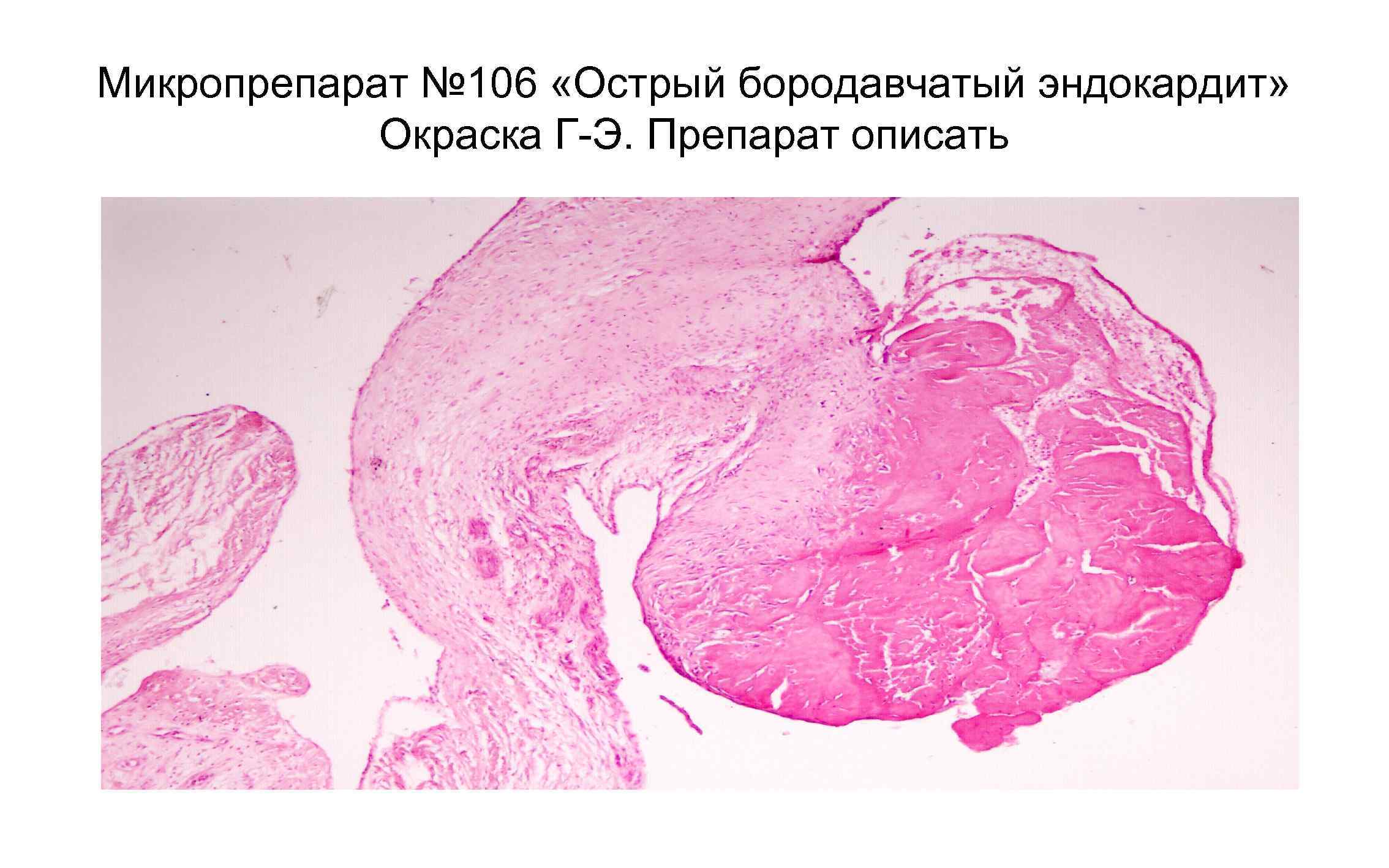 Что такое эндоцервикоз