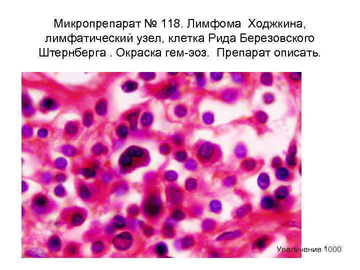 Что такое лимфома ходжкина фото