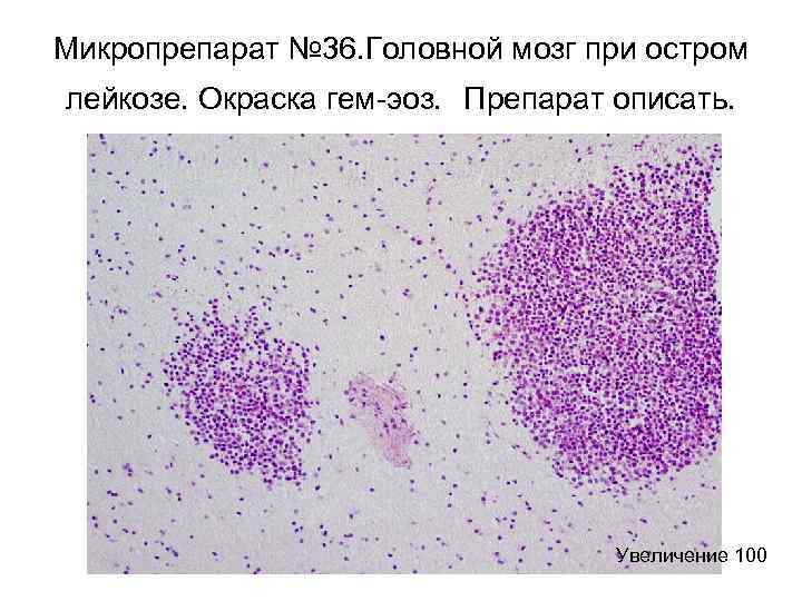 Мозг при остром лейкозе. Мозг при остром лейкозе микро. Острый лейкоз гистология. Костный мозг при остром лейкозе макропрепарат. Мозг при остром лейкозе микропрепарат.