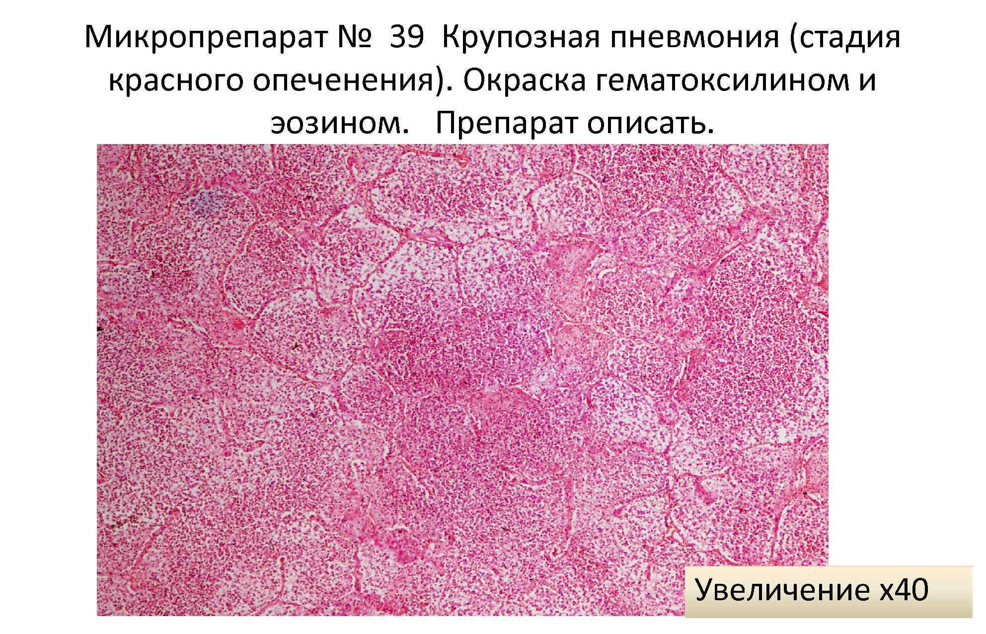 Описание микропрепарата. Крупозная пневмония окраска гематоксилин и эозин. Крупозная пневмония стадия серого опеченения микропрепарат. Пневмония патанатомия макропрепарат. Крупозная пневмония стадия красного опеченения макропрепарат.