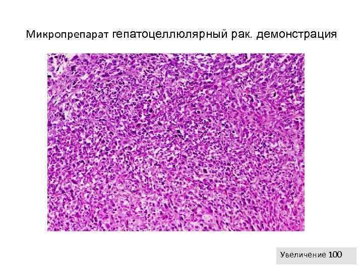 Хроническое венозное полнокровие печени микропрепарат рисунок