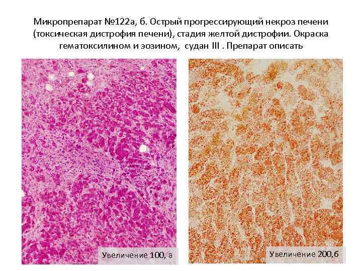 Жировая дистрофия печени рисунок микропрепарат