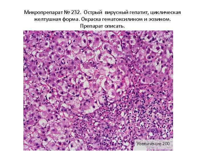 Солитарная гумма печени микропрепарат рисунок