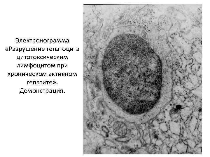 Хроническое венозное полнокровие печени микропрепарат рисунок