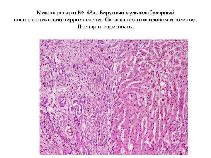 Микропрепарат № 43 а. Вирусный мультилобулярный постнекротический цирроз печени. Окраска гематоксилином и эозином. Препарат