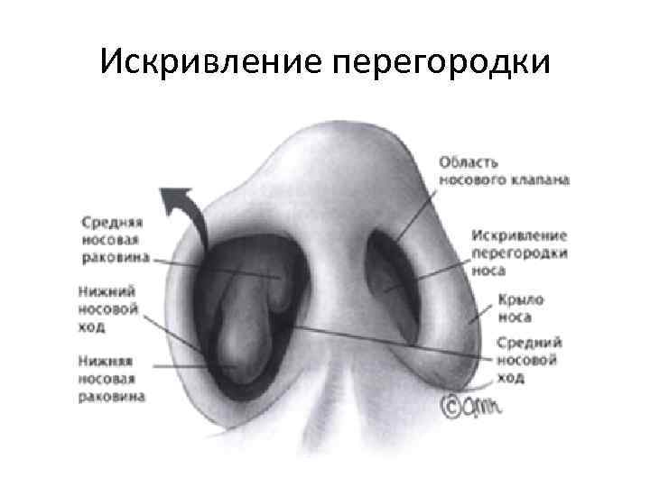 Искривление перегородки 