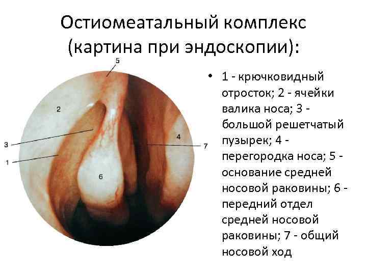 Остиомеатальный комплекс (картина при эндоскопии): • 1 - крючковидный отросток; 2 - ячейки валика