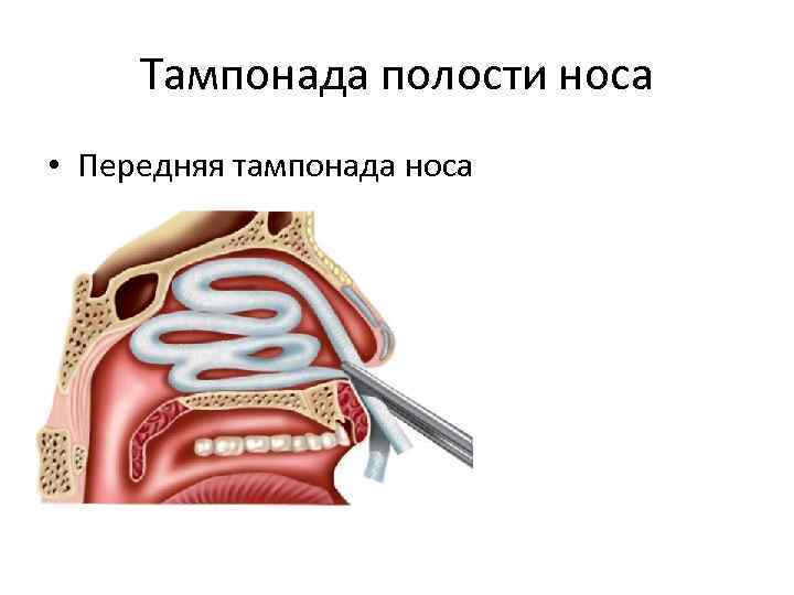 Тампонада полости носа • Передняя тампонада носа 