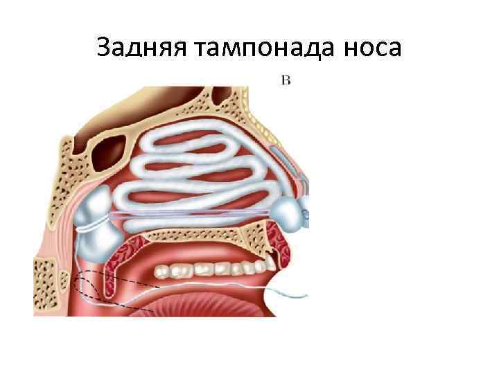 Задняя тампонада носа 