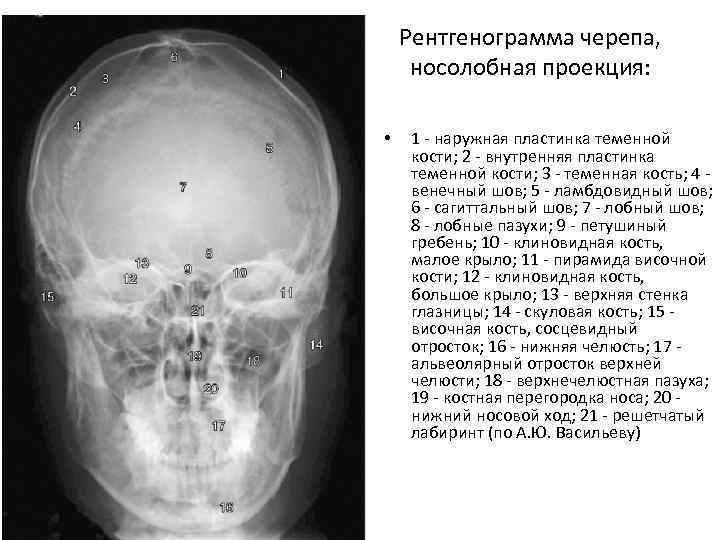 Рентгенограмма черепа, носолобная проекция: • 1 - наружная пластинка теменной кости; 2 - внутренняя