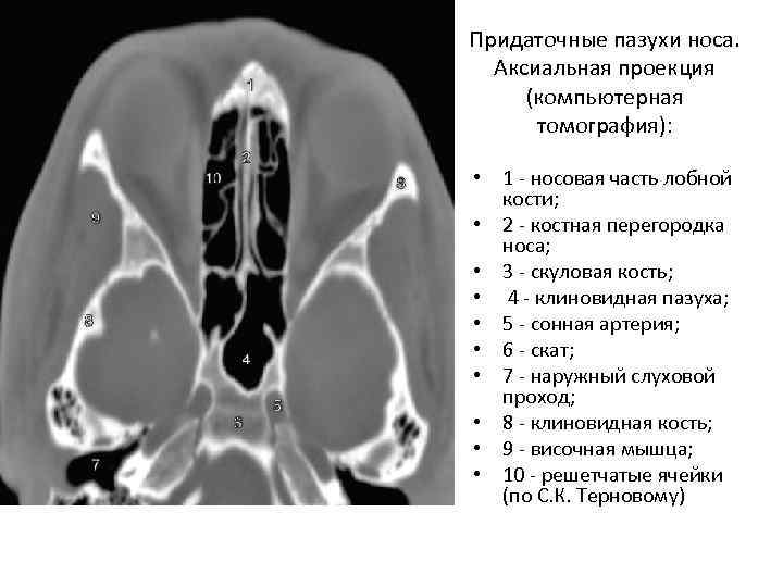 Придаточные пазухи носа. Аксиальная проекция (компьютерная томография): • 1 - носовая часть лобной кости;