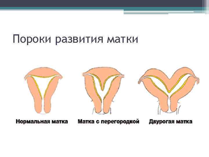 Пороки развития матки 